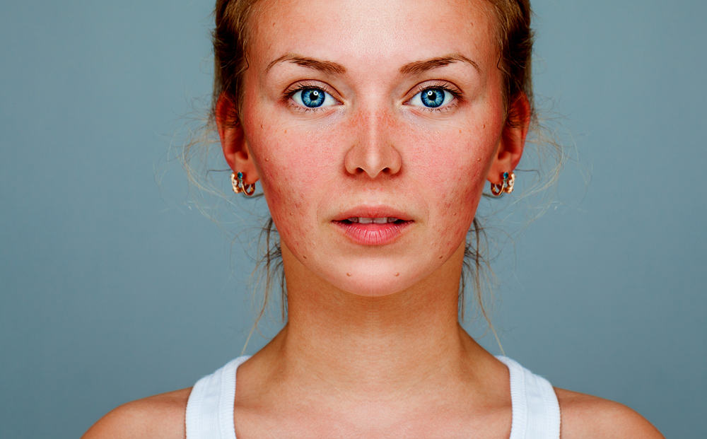 What Are The Best Natural Rosacea Treatments?
