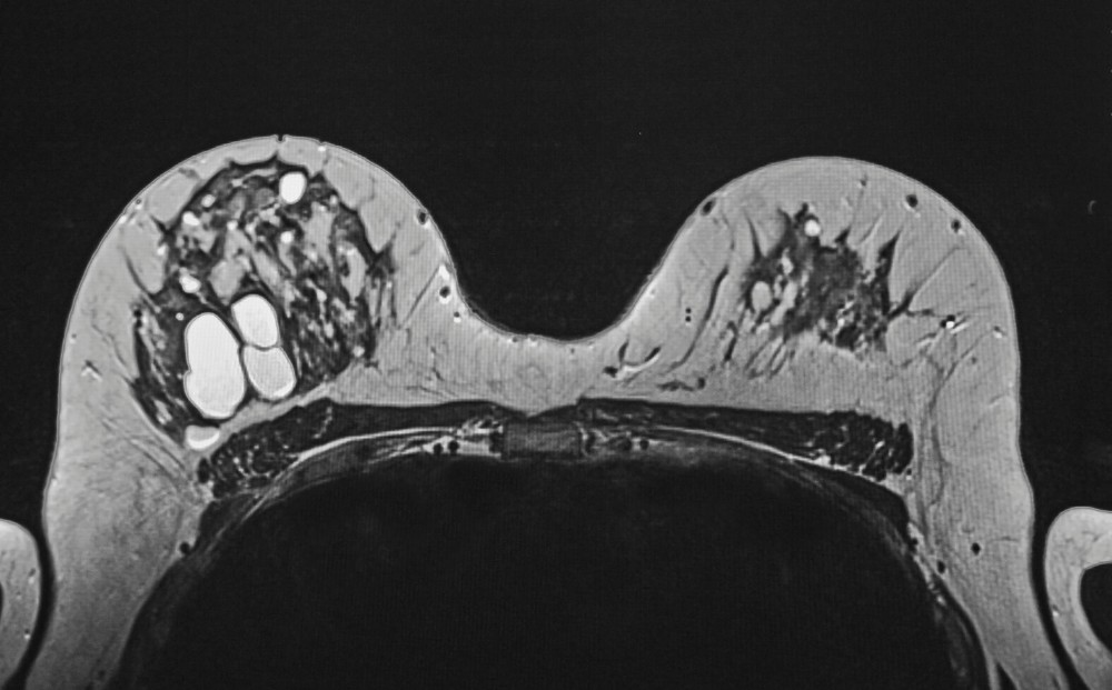 Everything You Want To Know About Sebaceous Cysts