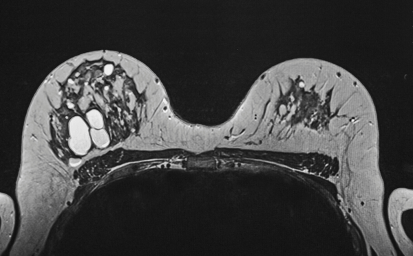 Everything You Want To Know About Sebaceous Cysts